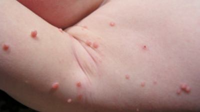 Molluscum Contagiosum: l’infezione della pelle comune nei bambini